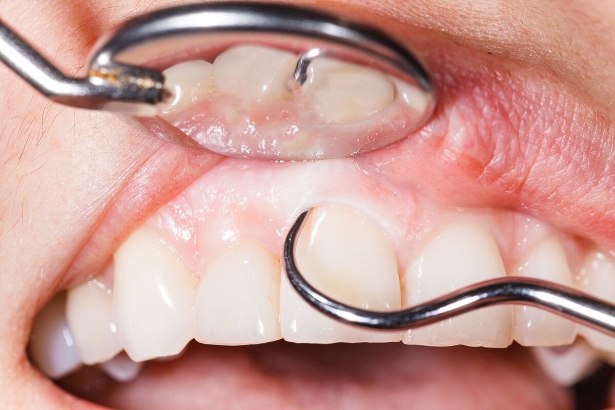Dental professional examining patient's gums and teeth during oral examination with dental instruments.