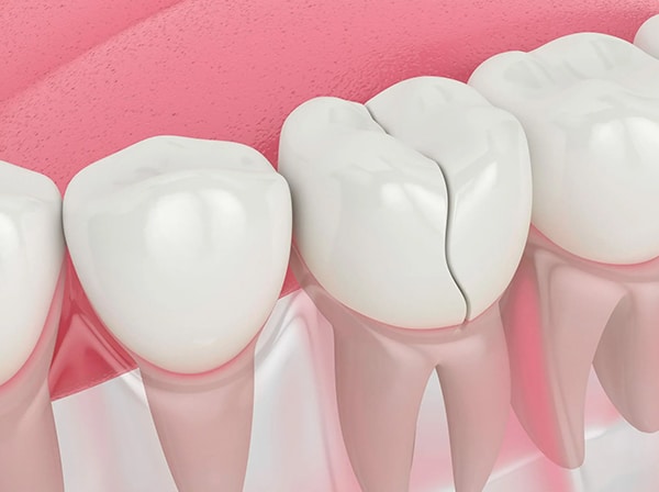 Animated white teeth with crack on pink background representing dental damage and treatment needs.