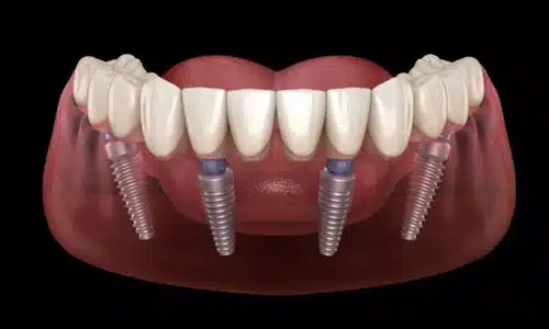 Dental implant model showing four titanium implants in lower jaw with prosthetic teeth.