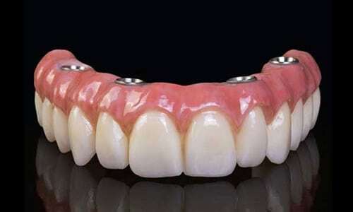 Dental prosthetic showing upper teeth bridge with pink gum-colored acrylic base against black background.