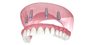 Dental implants diagram showing three titanium posts anchored in jawbone supporting artificial teeth.