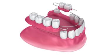 Dental implant models displaying prosthetic teeth and gum structure on pink base.