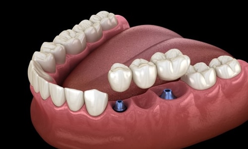 Dental implant model showing two blue and purple implant posts in pink gum tissue with artificial teeth.