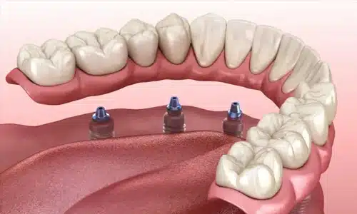 Dental implant model showing three titanium implants positioned in lower jawbone with natural teeth.
