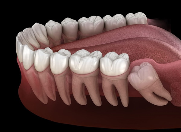 3D dental illustration showing natural teeth and gum anatomy in cross-section view.