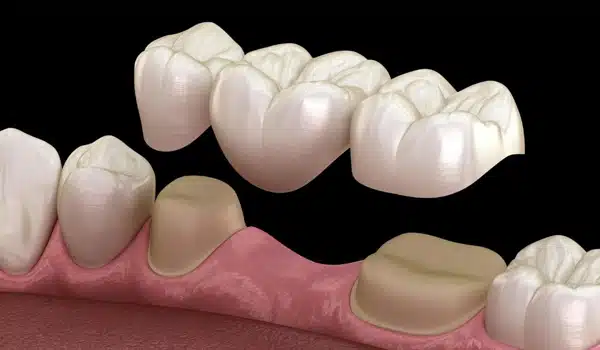 Dental bridge restoration showing artificial teeth attached to natural tooth structure and gum tissue.