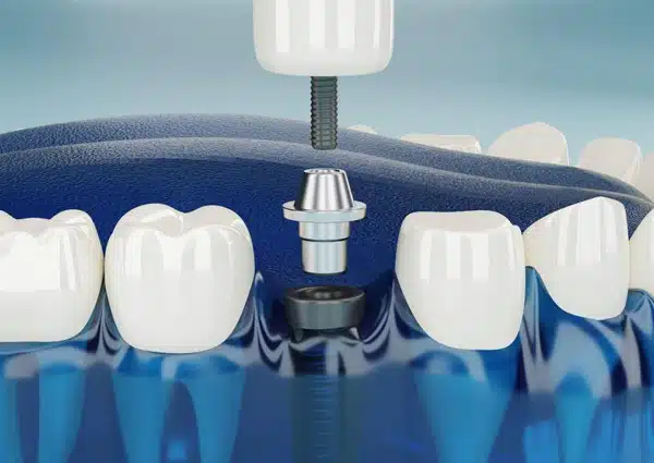 Dental implant diagram showing tooth replacement procedure with crown and implant structure in blue medical illustration.