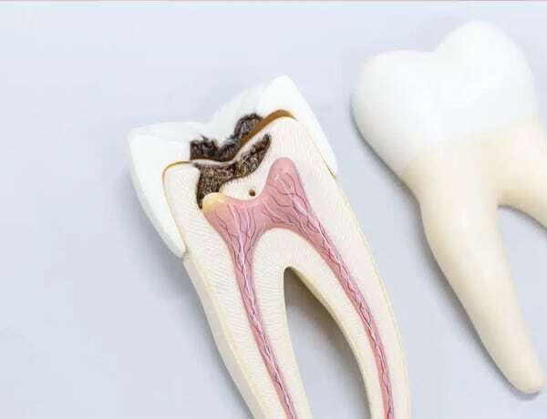Dental cross-section model showing tooth decay in pulp chamber next to intact tooth model.