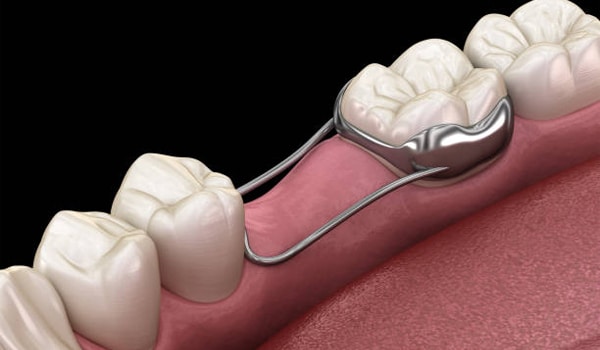 3D dental illustration showing bridge restoration procedure with artificial tooth placement on gum tissue.