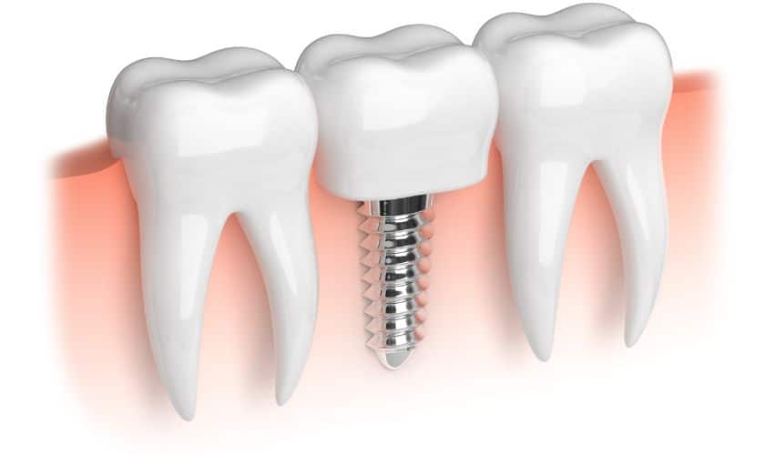 Dental Implants Brighton