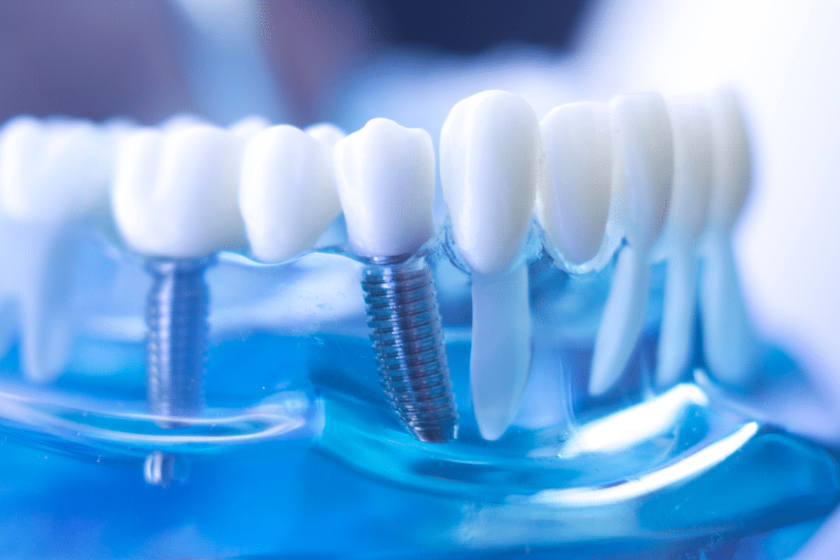 Dental Implants Healing Process: What to Expect
