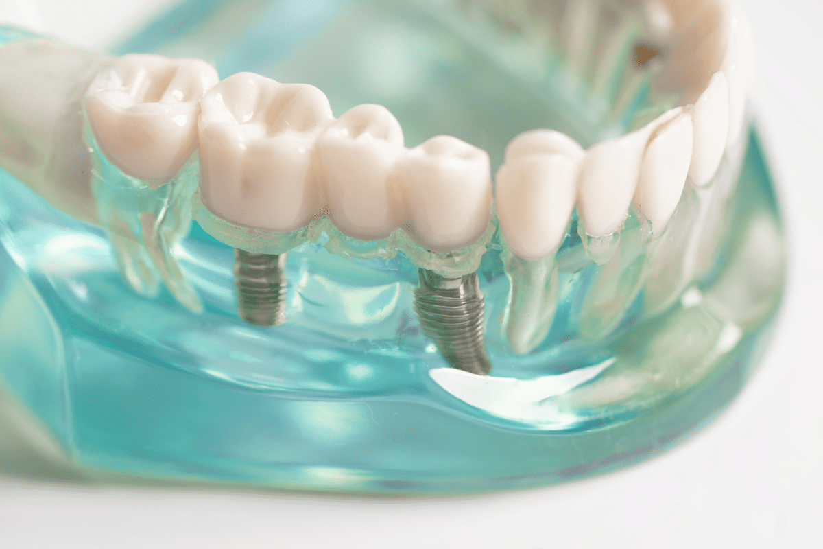 How Long Do Dental Implants Last? Know from our Brighton Team