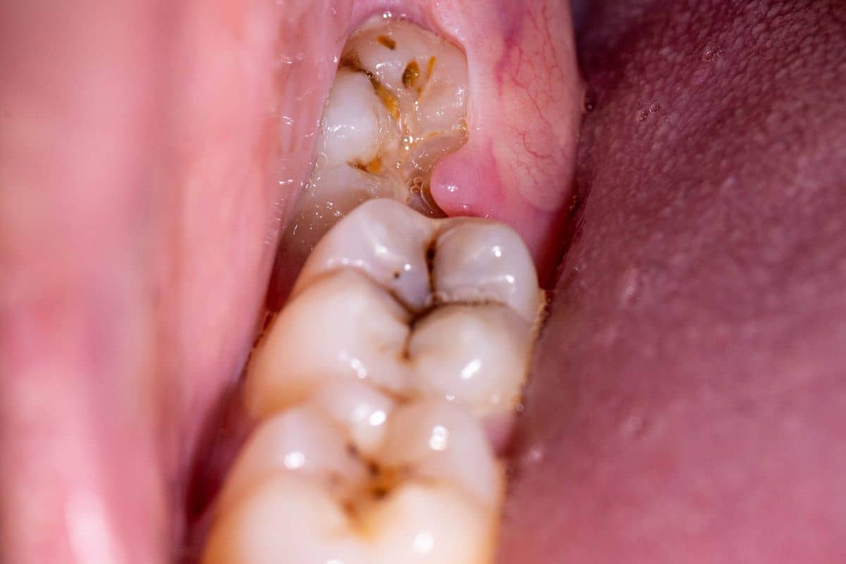 wisdom teeth removal