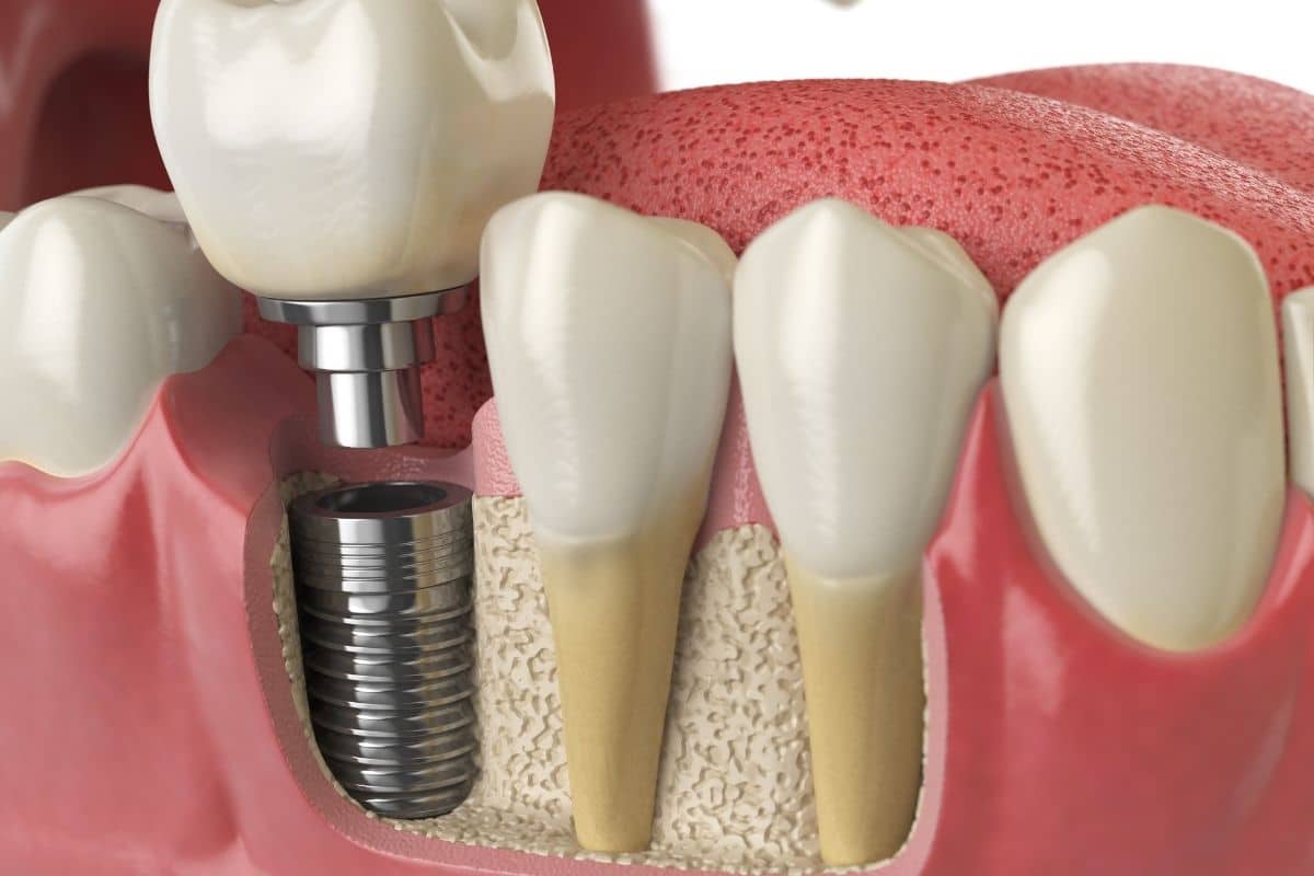 dental implants brighton