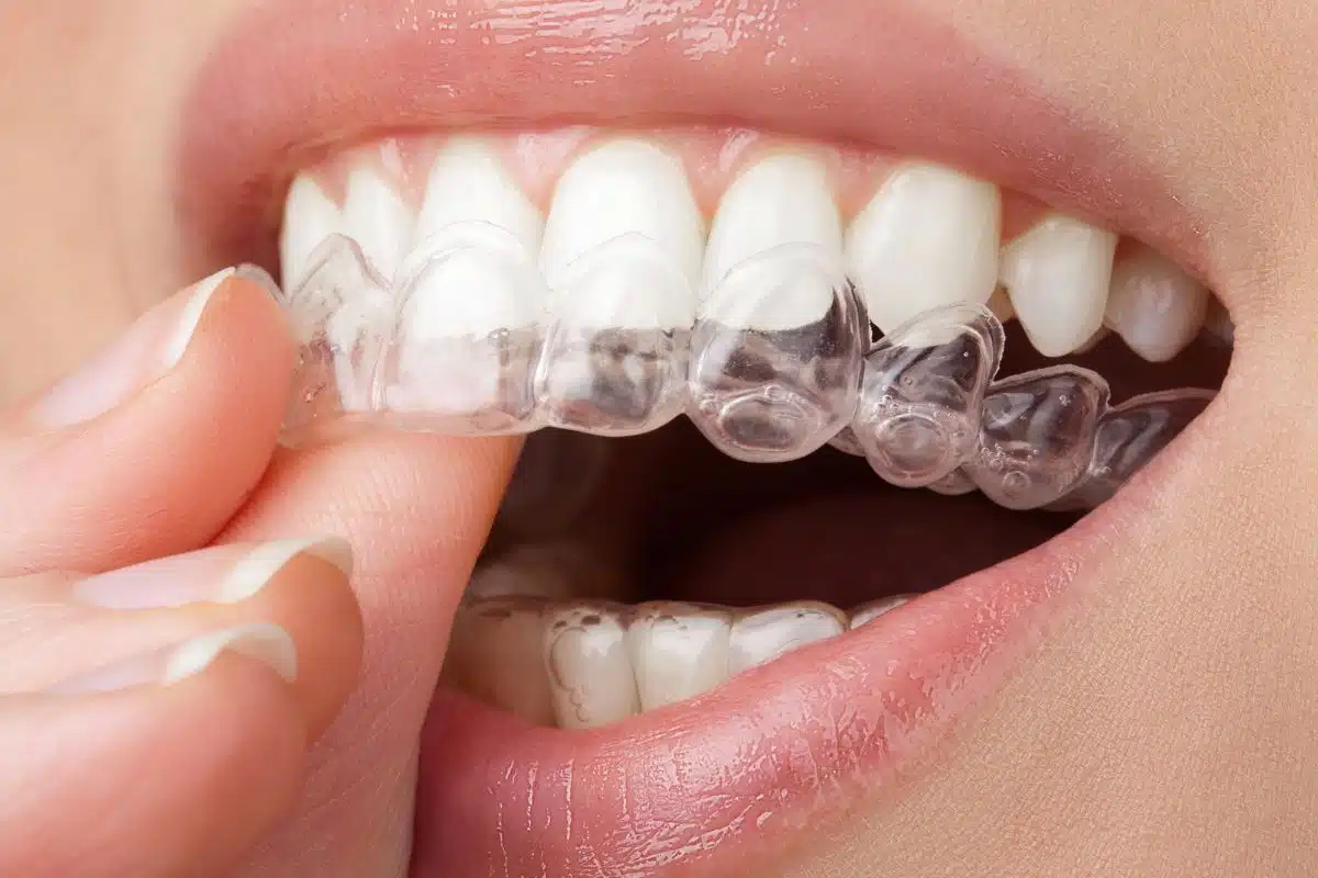 Patient placing clear aligners during clear aligner treatment