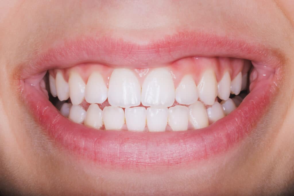 Patient with uneven tooth shapes before porcelain veneer treatment